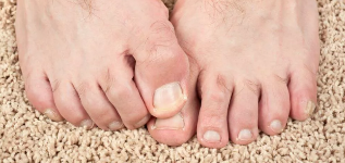 D ' Behandlung vun Nagelpilz